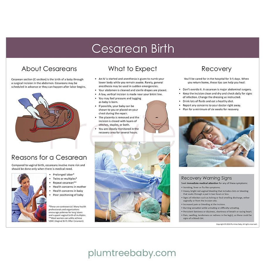 Cesarean Birth Poster - Large / English