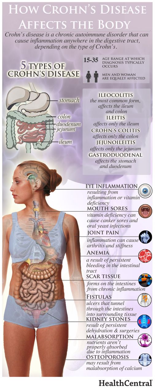 How Crohn's Disease Affects The Body (INFOGRAPHIC) - What is IBD? - Digestive Health