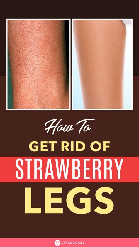 10 Natural Ways To Get Rid Of Strawberry Legs