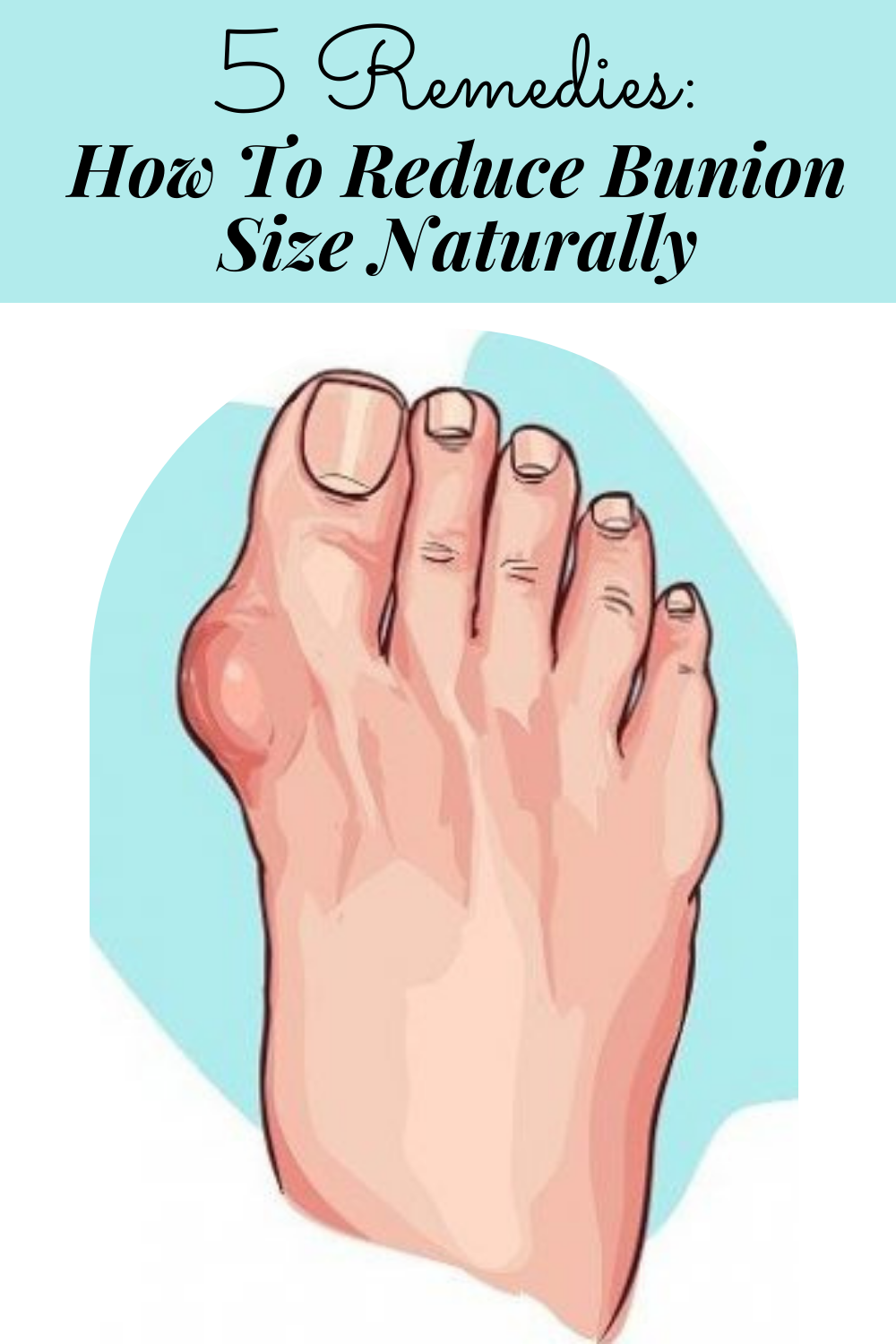5 Remedies: How To Reduce Bunion Size Naturally