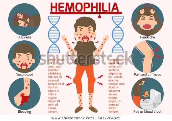 Hemophilia Symptom Infographics Elements Sign Symbols Stock Vector (Royalty Free) 1477204325 | Shutterstock
