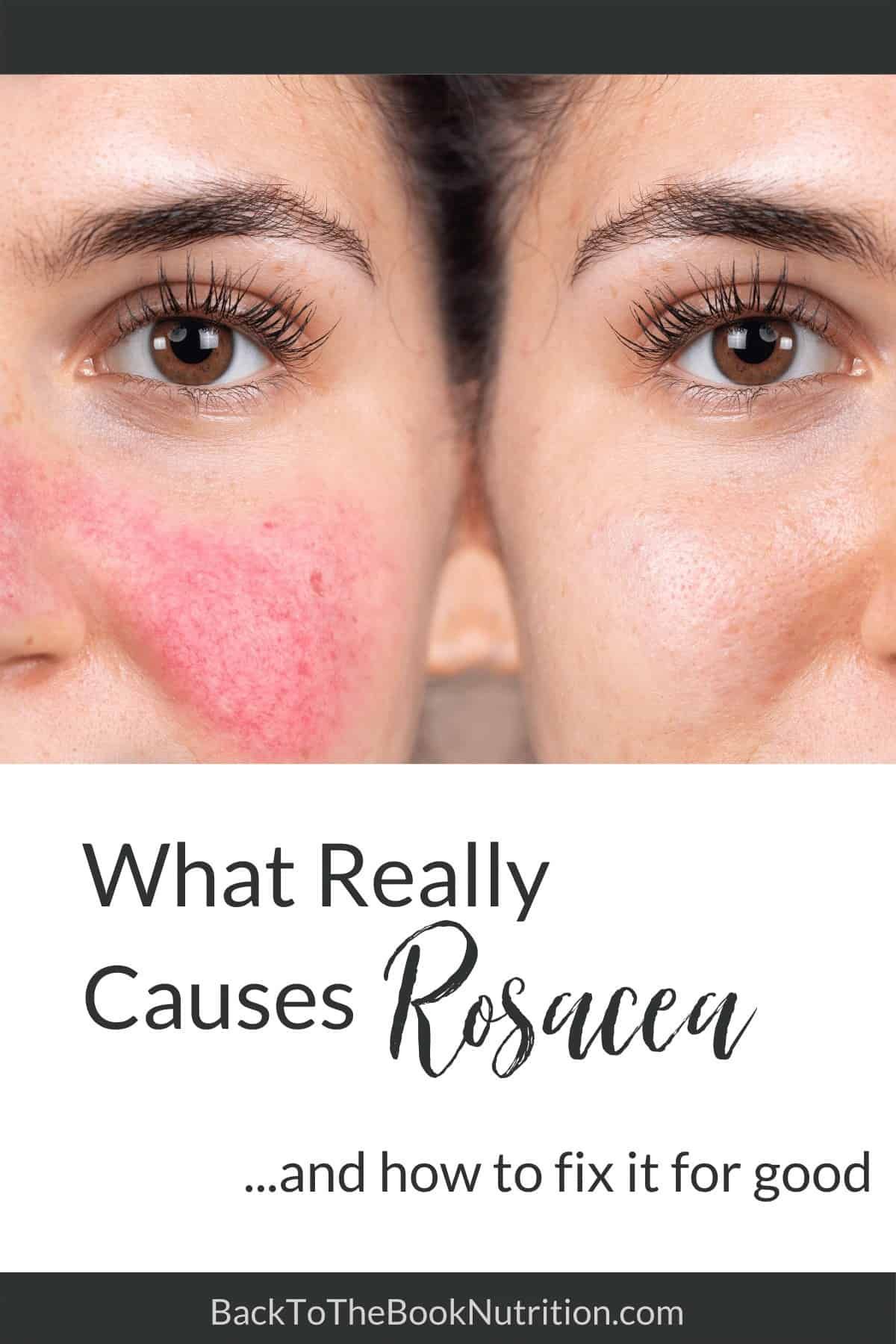 What Really Causes Rosacea and How to Overcome it Naturally