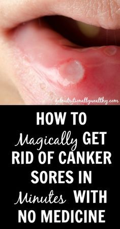 How To Naturally Get Rid of Canker Sores In Minutes With No Medicine!