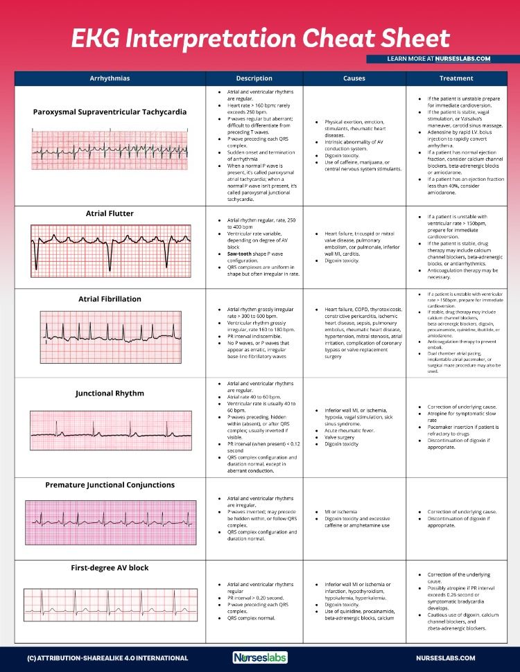 EKG Interpretation Cheat Sheet & Heart Arrhythmias Guide