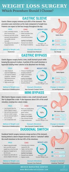 Guide to Types of Weight Loss Surgery