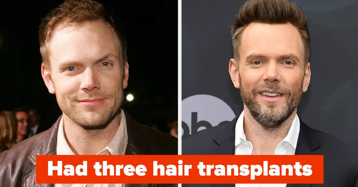 Male Celebs Discuss Hair Transplants and Wigs