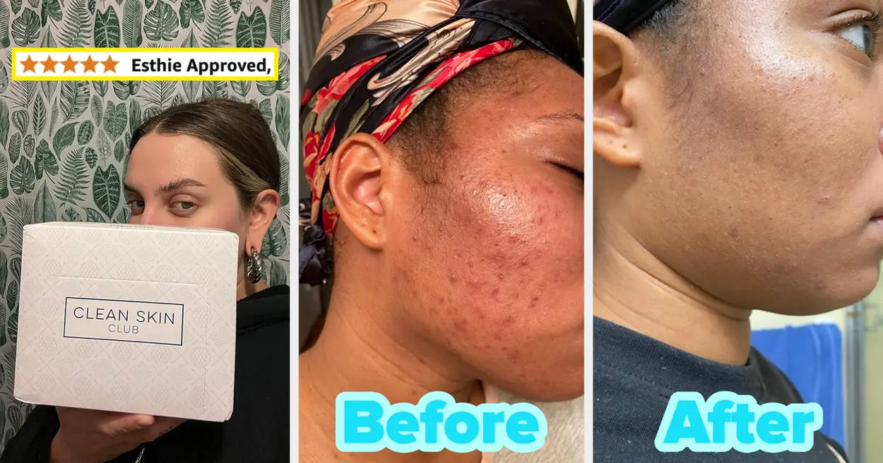 26 Skincare Products For Acne Reviewers Recommend