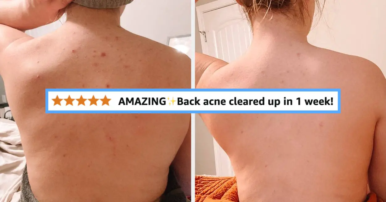 27 Reviewer-Loved Products For Acne-Prone Skin