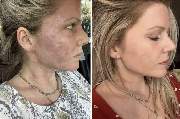 28 Skincare Products With Before & After Photos So Dramatic, We Made Them Click To Reveal