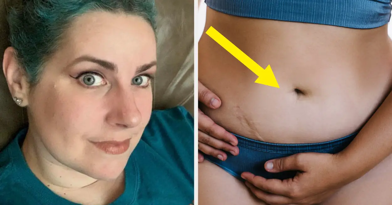 How My Belly Button Saved My Life From Ovarian Cancer